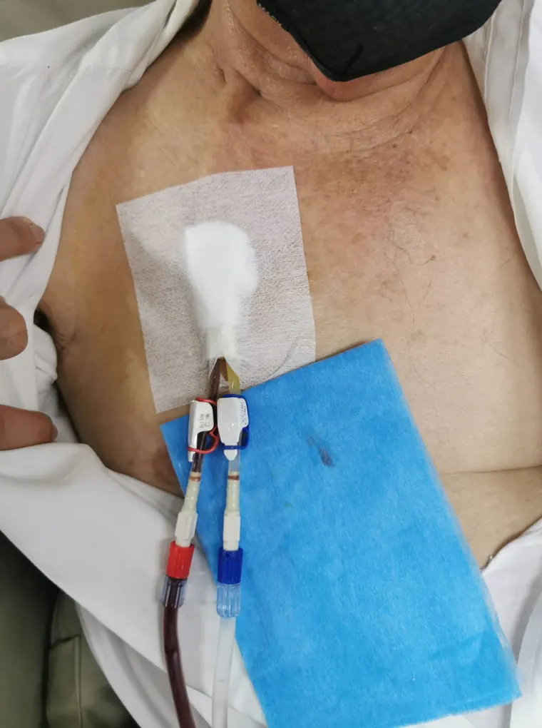 Catéter para hemodiálisis recién colocado en el cuello de un paciente